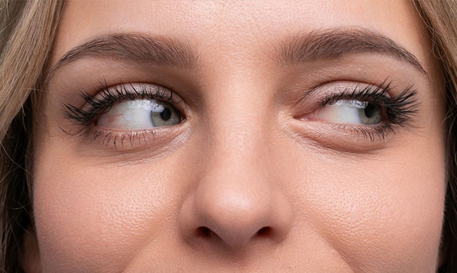 SULANMA VE KAŞINTI VARSA DEMODEX PARAZİTİNE DİKKAT